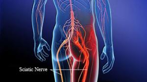 sciatica