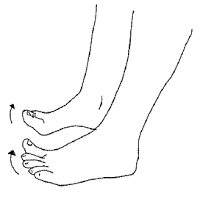 plantar fasciitis