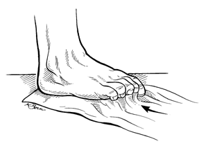 plantar fasciitis