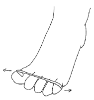 plantar fasciitis