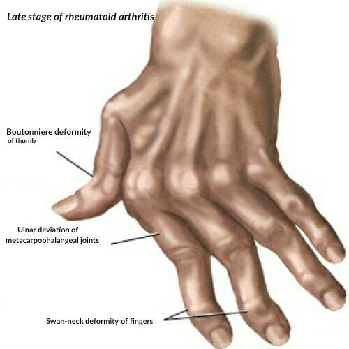 Rheumatoid Arthritis