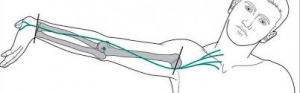 Cubital Tunnel Syndrome