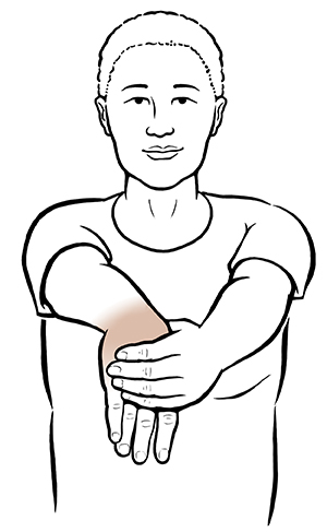 Radial nerve compression